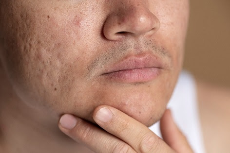 Dermatologista explica o que são e como lidar com as cicatrizes na pele