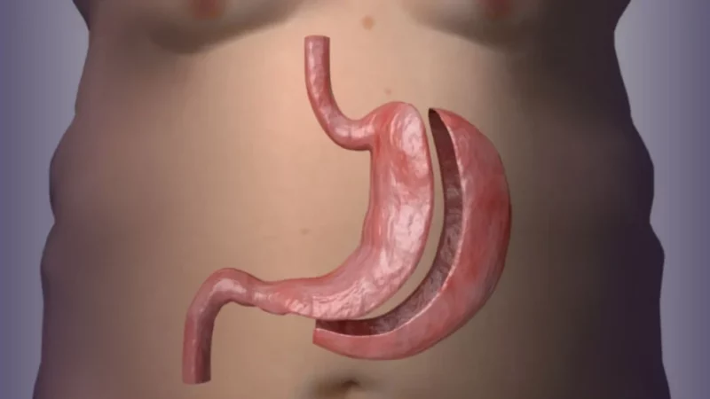 CFM publica resolução que estabelece novos parâmetros para a cirurgia bariátrica e metabólica no Brasil