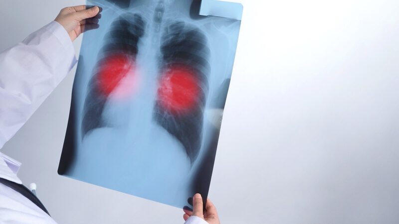 Tuberculose: mortes recuam 14,8% no AM, mas idosos ainda preocupam