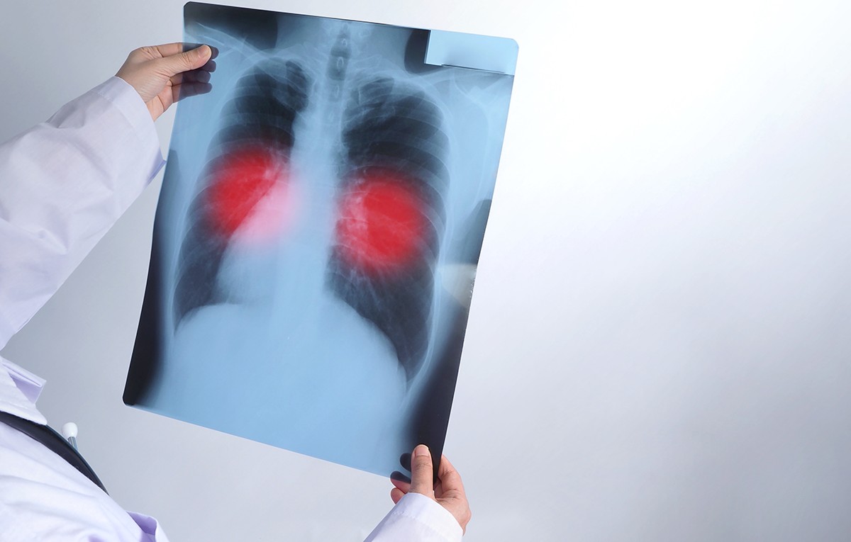 Tuberculose: mortes recuam 14,8% no AM, mas idosos ainda preocupam